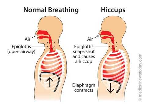 Hiccups Causes And Treatments
