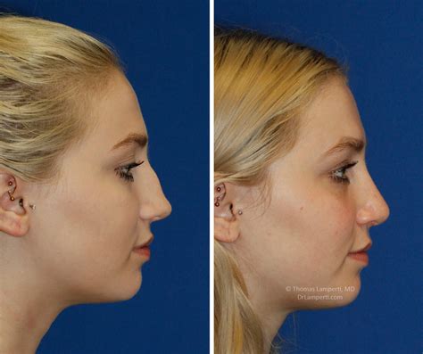 Celebrity Septoplasty Before And After