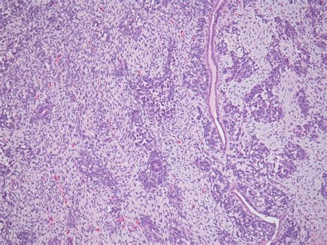 Pathology Outlines Nephroblastomatosis Nephrogenic Rests