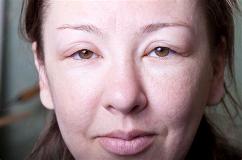 How To Reduce A Swollen Face Simple Tips