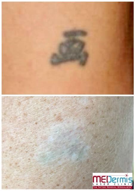 Photo Gallery Laser Tattoo Removal Before And After Results Medermis