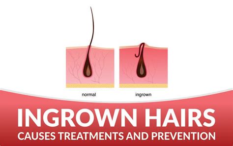 Ingrown Hairs Causes Prevention And Treatment Handf Magazine