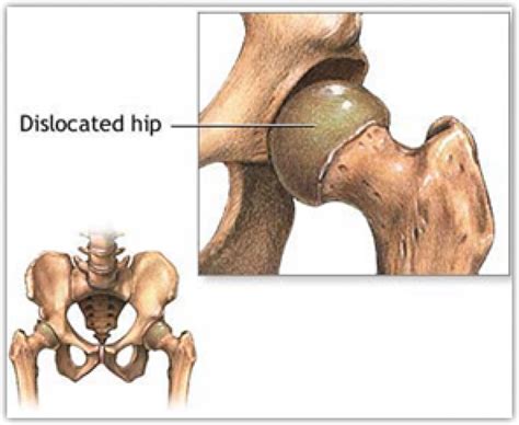 Hip Dislocation A Runners Manual To Treating And Preventing This Injury