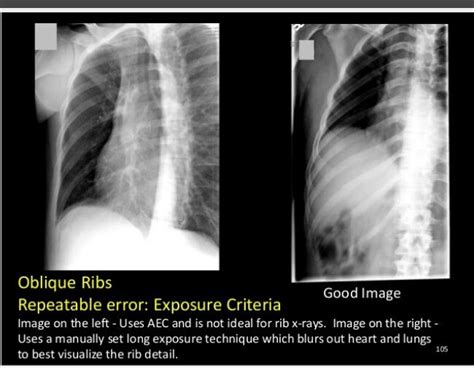 Oblique Ribs Radiology Technician Nuclear Medicine