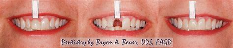 Implant Or Bridge Pros And Cons Bauer Smiles Wheaton Dental Impants