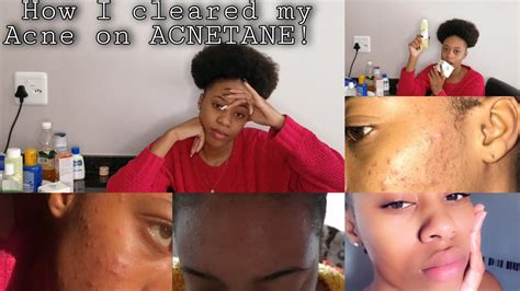 How I Cleared My Acne On Acnetane Youtube