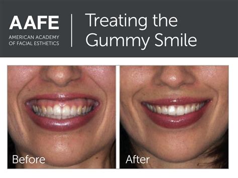 Gummy Smiles Are Successfully Treated With Botox When Performed By Expert Injectors Facial