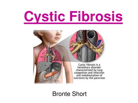 Ppt Cystic Fibrosis Powerpoint Presentation Free Download Id 4492975