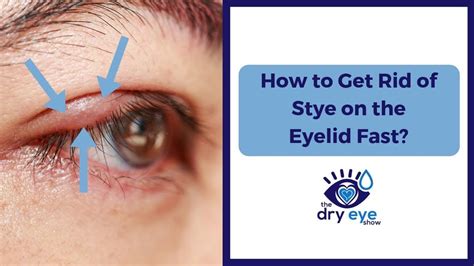 👁️👁️ How To Get Rid Of A Stye On The Eyelid Fast 👁️👁️ Eye Stye