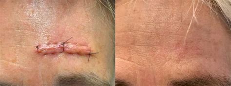 Scar Solutions Correction Aesthetic Results