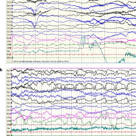 E Ictal Eeg Of A Child With Benign Sleep Myoclonus In The Modified