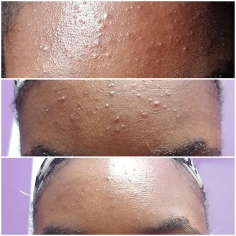 Beforeandafter Recently Diagnosing And Treating My Fungal Acne