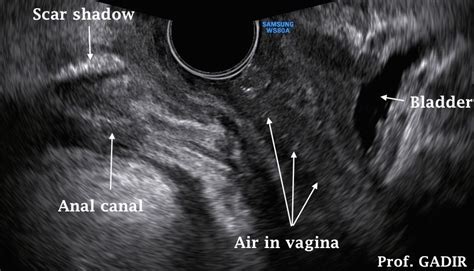 Above 3 Images Show Longitudinal View Of A Normal Looking Tubular Cervix Longitudinal View Of