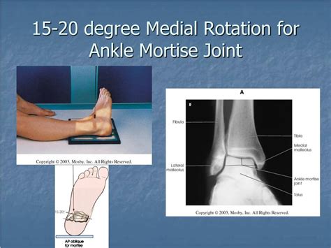 Ankle Mortise Joint X Ray Polymed Lab