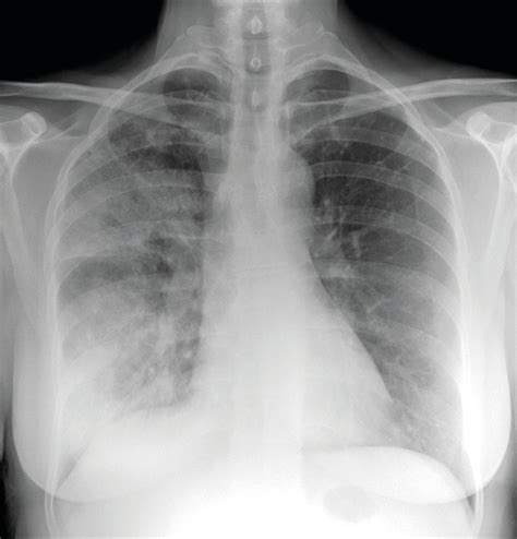 Death Rates From Community Acquired Pneumonia Falling In Nhs Hospitals