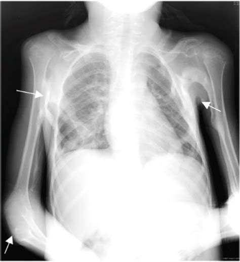 Chest Radiograph Displaying The Anteroposterior Ap View With