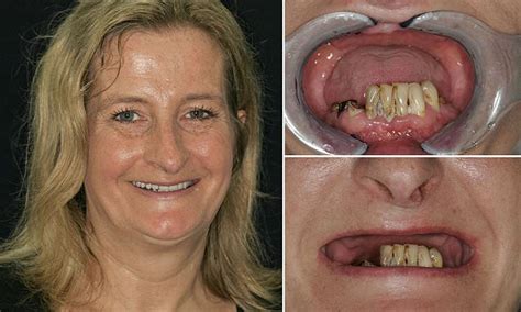 Woman Had All Her Top Teeth Removed By Dentist Without Her Consent
