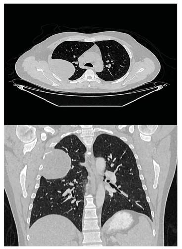 Primary Pleural Schwannoma As Incidental Findings An Unusual Case