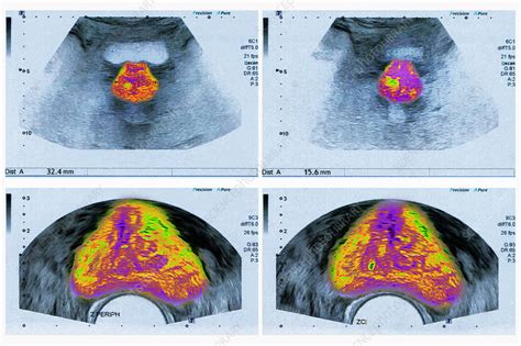 Prostate Pelvic Ultrasound Stock Image C0272760 Science Photo