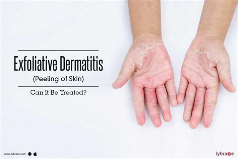 Exfoliative Dermatitis Peeling Of Skin Can It Be Treated By Dr
