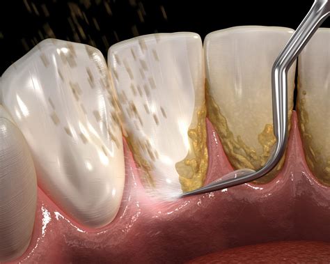 Periodontal Scaling And Root Planing 3d Dentistry In Bradenton Fl