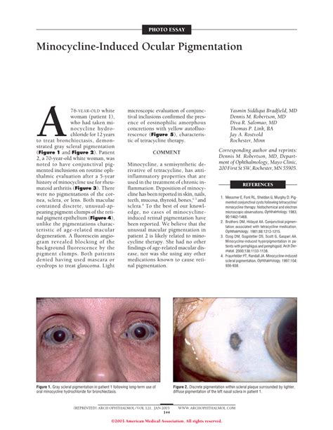 Minocycline Induced Ocular Pigmentation Dermatology Jama