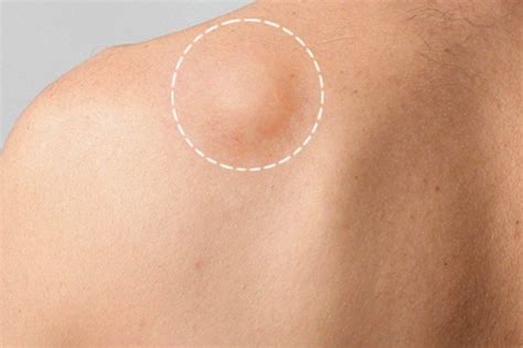 How To Remove A Lipoma Yourself Check It Out Guideline