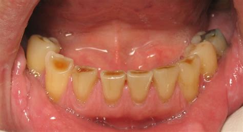 Teeth Grinding United Dentist
