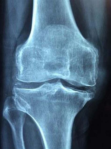 Diagnosing Osteoarthritis Shruti Debnath