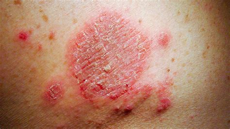 Whats That Rash On Your Body