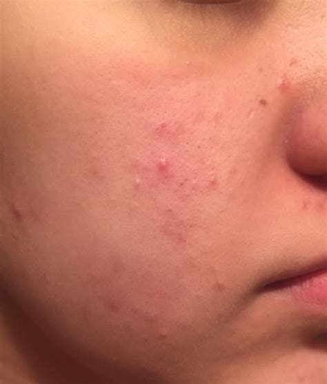Weird Acne All Over Face General Acne Discussion
