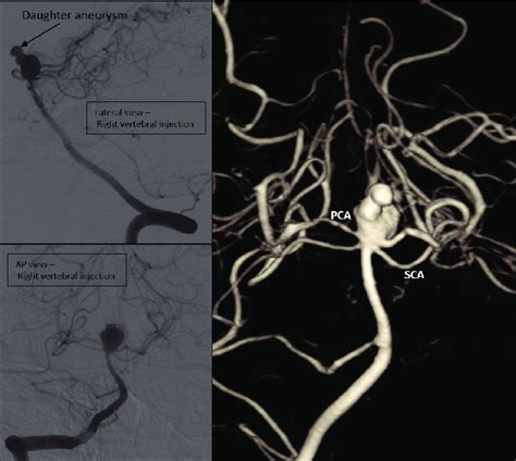 Saccular Basilar Top Aneurysm With Eccentric Outpouching Daughter