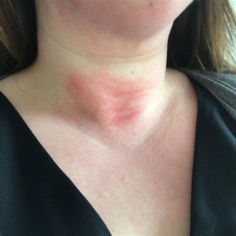 How To Treat Skin Discoloration On The Neck Heidi Salon