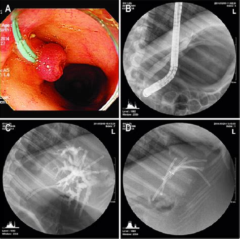 Endoscopic Procedures In The Animal Bile Duct Dilation Model A A