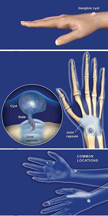 Ganglion Cysts Of The Hand Central Coast Orthopedic Medical Group