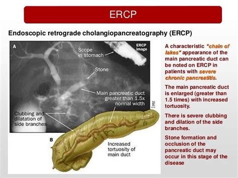 Chronic Pancreatitis