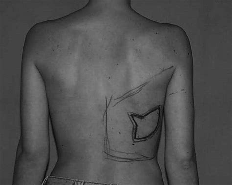 The Design Of The Latissimus Dorsi Myocutaneous Flap With A Triangular