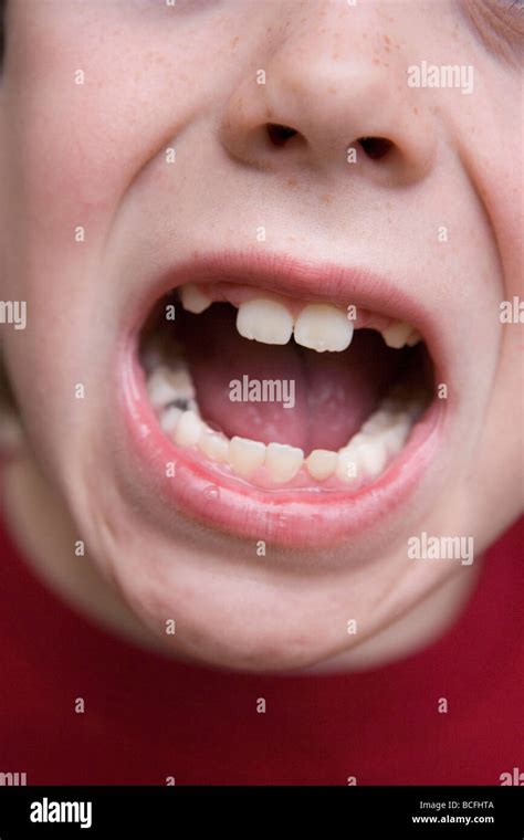 Close Up Of Seven Year Old Child Mouth With Missing Teeth Stock Photo
