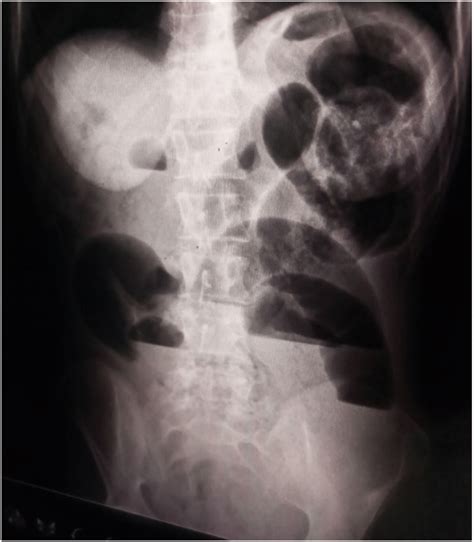 Plain Abdominal X Ray Showing Distended Bowel Loops With Air Fluid