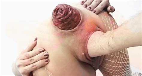 See And Save As Anal Gape Prolapse Fisting Extreme Best Gifs Porn Pict