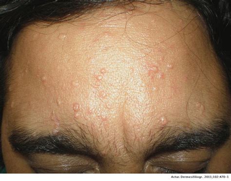 Pulsed Dye Laser Treatment For Multiple Sebaceous Hyperplasia Secondary To Ciclosporin Actas