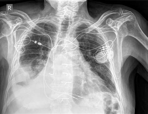 Biventricular Pacemaker Chest X Ray
