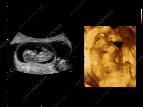 12 Week Old Triplet Foetuses Ultrasound Scans Stock Video Clip