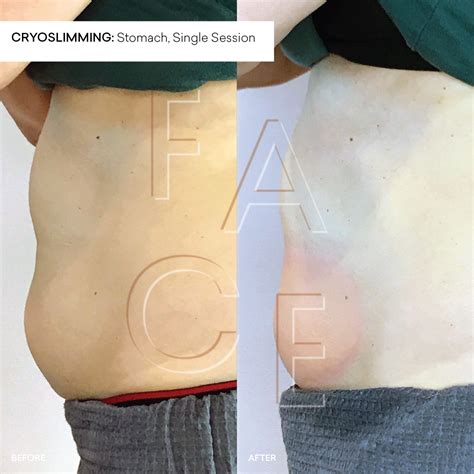 Cryoskin Before And After Stomach Slimming — Face