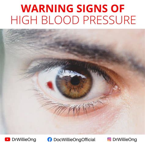 Warning Signs Of High Blood Pressure Doc Willie Ong
