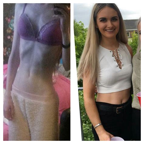 Brave Donegal Student Michaela Duddy Overcomes Anorexia Demons After Weight Plummeted To Under