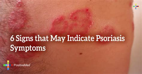 6 Signs That May Indicate Psoriasis Symptoms Positivemed