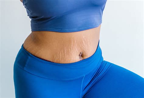 5 Fast And Effective Ways To Hide Stretch Marks On Your Stomach