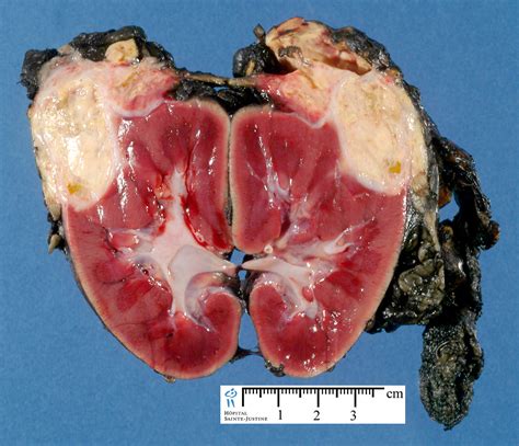renal tumors - Humpath.com - Human pathology