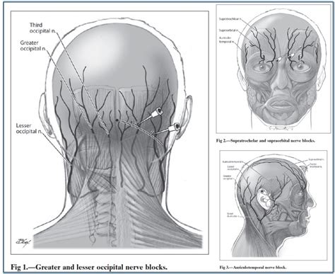 Cluster Headaches Diagram